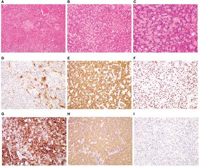 Coexistence of a novel STRN-ALK, NBEA-ALK double-fusion in an ovarian malignant mesothelioma patient: a case report and review